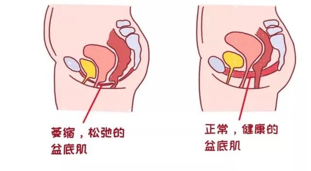 盆底肌.jpeg
