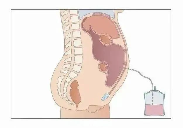 腹腔穿刺置管.jpeg
