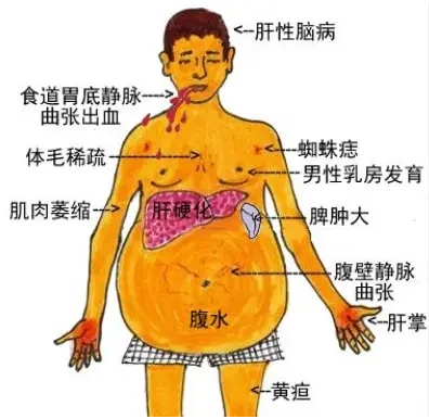 肝腹水.png