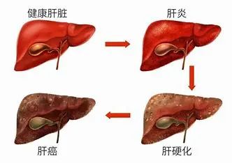 肝硬化的过程.jpeg