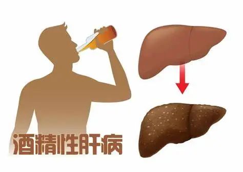 酒精性肝病.jpeg