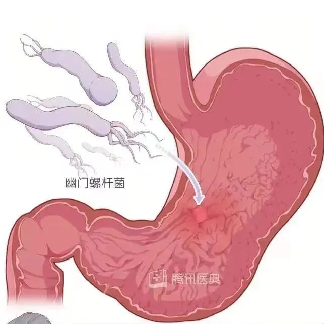 幽门螺杆菌.jpeg