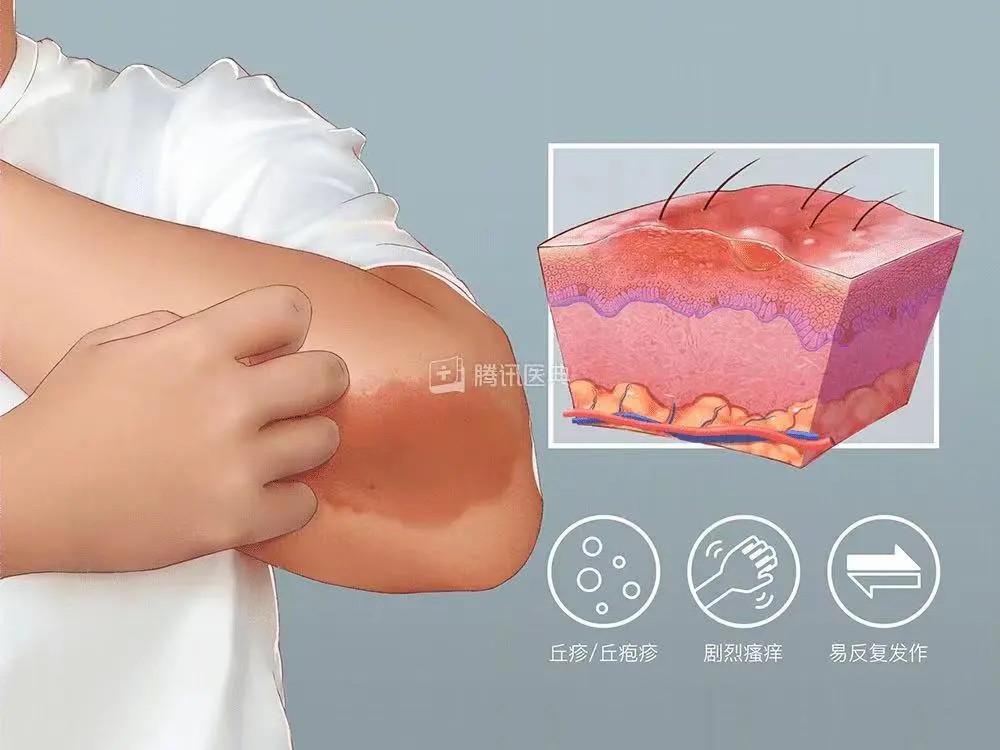 湿疹的皮肤.jpg