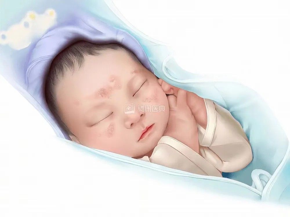 小孩子得湿疹.jpg