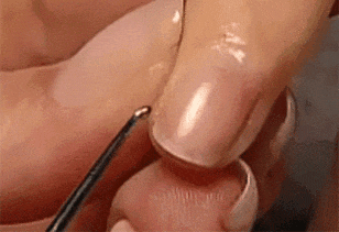专业甲沟炎修复.gif
