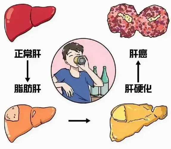 正常肝-脂肪肝.jpg