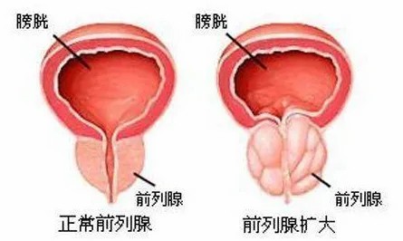 正常前列腺和扩大后.jpg