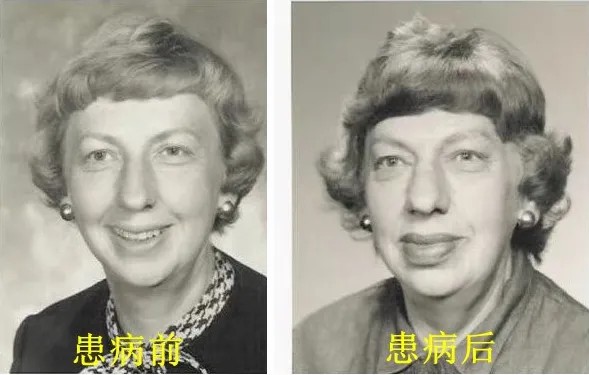 患病前后对比图.jpg
