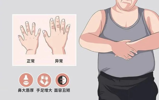 肢端肥大症.jpg