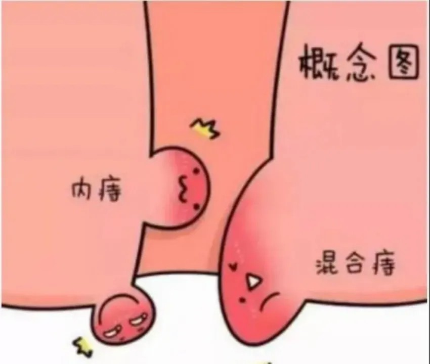 内痔.jpg
