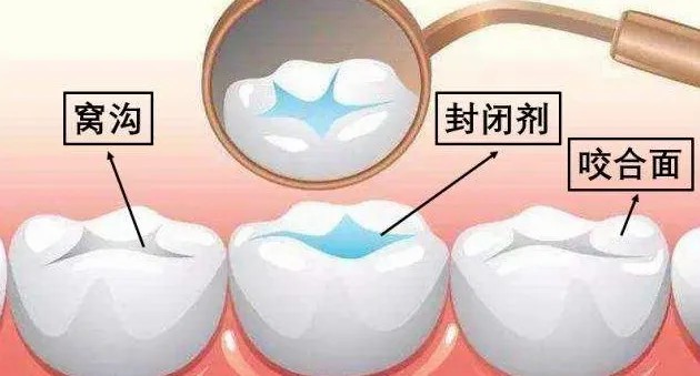 窝沟封闭.jpg