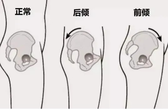 骨盆前后倾.jpg