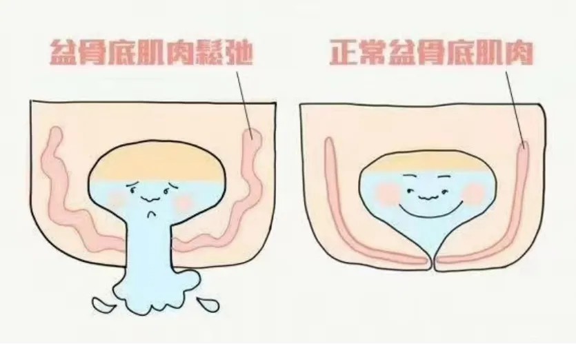 盆骨底肌肉松弛.jpg