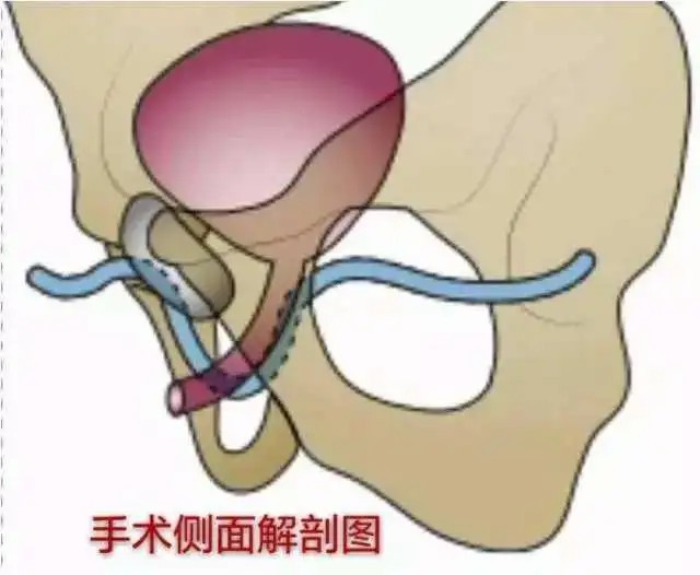 手术侧面解剖图.jpg