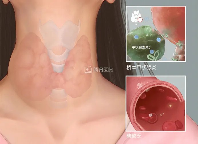 甲状腺展示.jpg