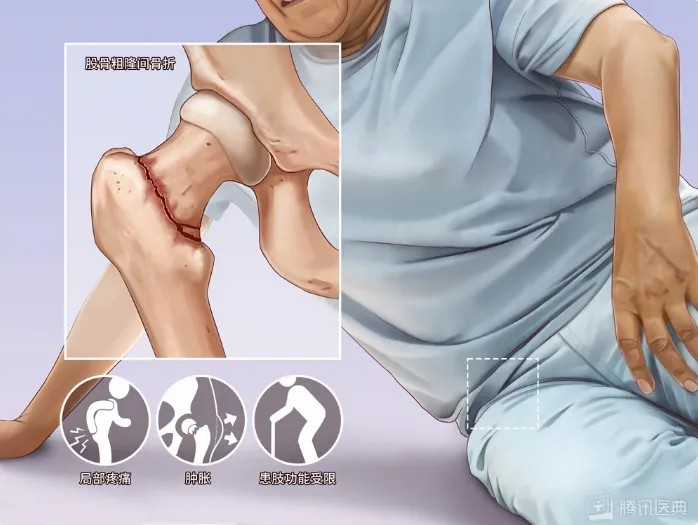 股骨粗隆间骨折.jpg