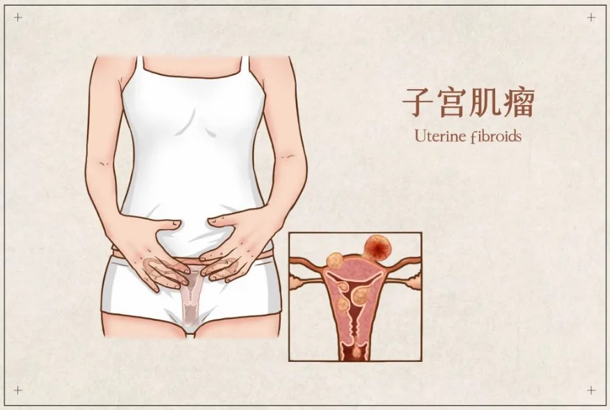 子宫肌瘤.jpg