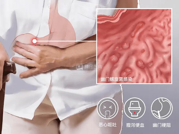 胃息肉.jpg