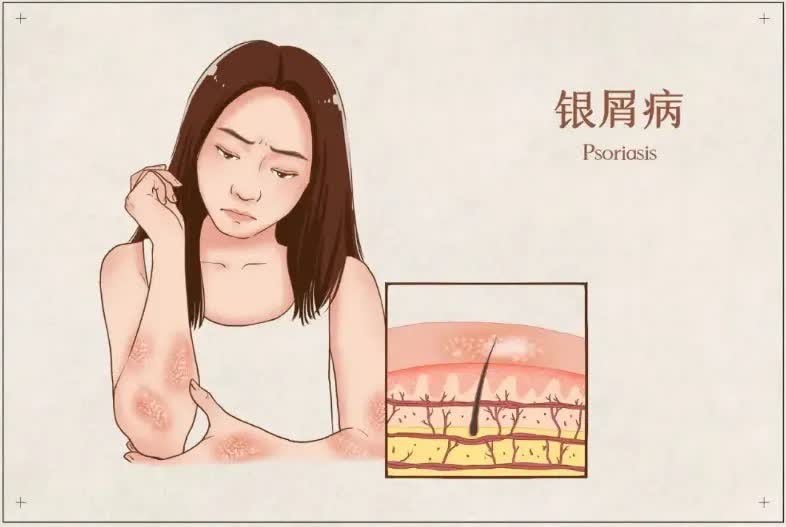 银屑病.jpg