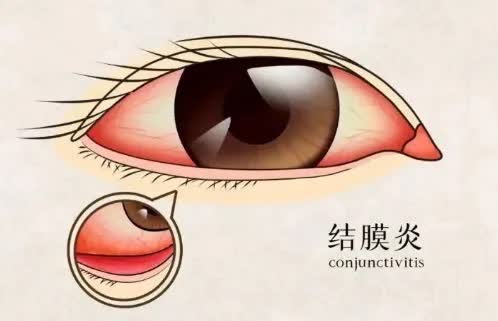 过敏性结膜炎1.jpg
