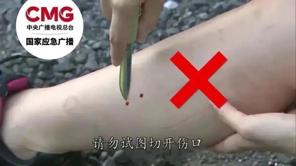 切开伤口排毒.jpg