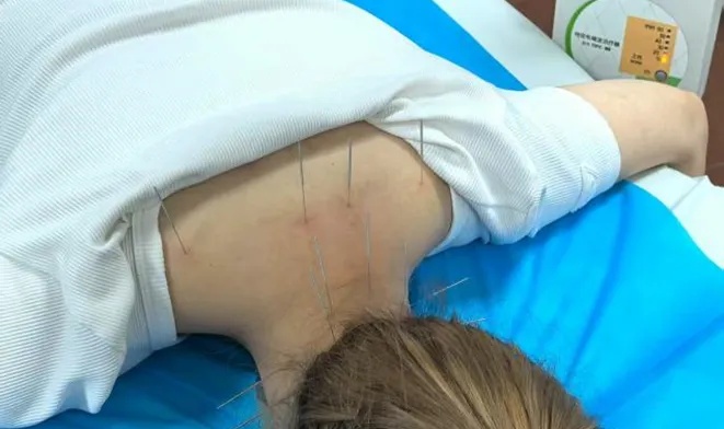 针灸疗法.jpg