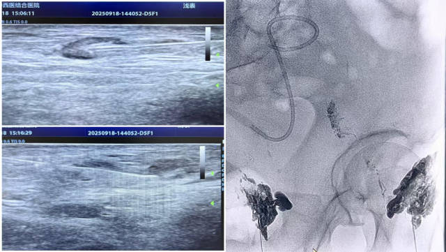 淋巴结造影+栓塞 淋巴结造影+栓塞