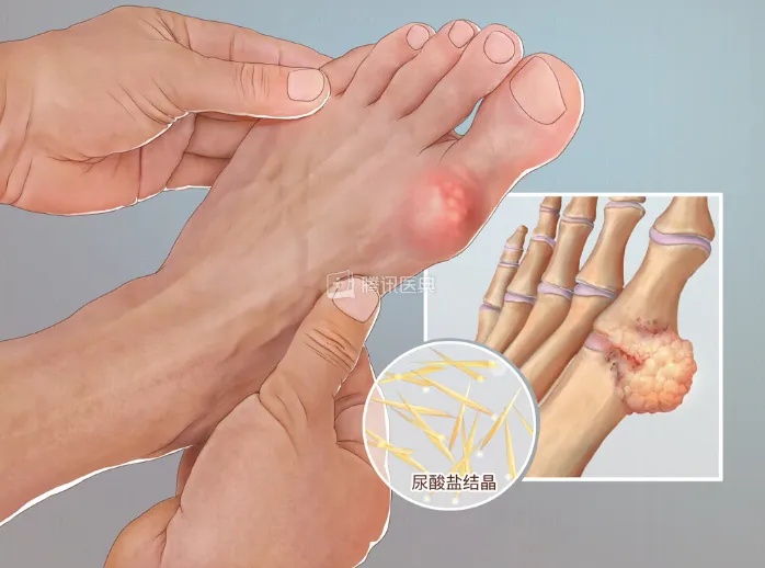 痛风性关节炎.jpg