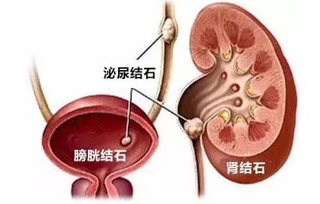 泌尿结石.jpg
