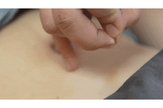 针刺疗法.gif
