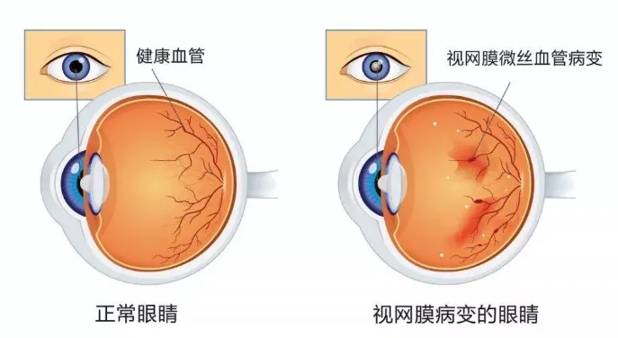 眼球.jpg