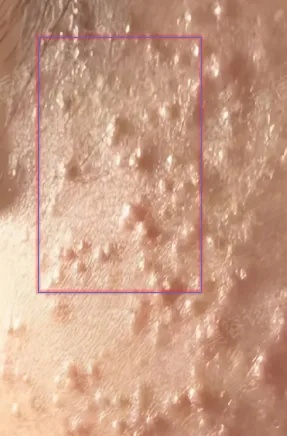 质地坚硬、密集成片的痘痘.jpg