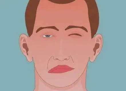 面肌痉挛.jpg