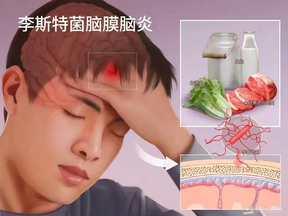 脑膜炎.jpg