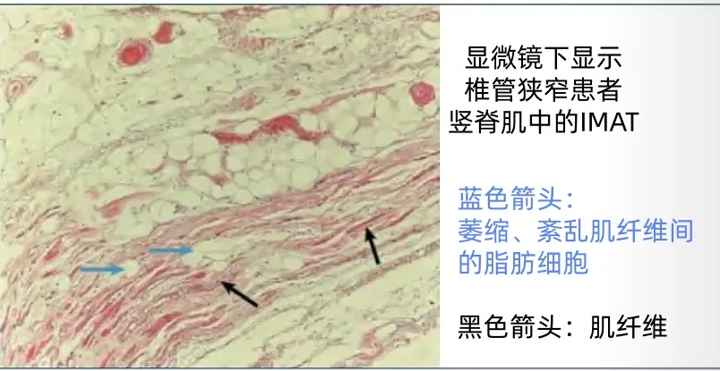 肌间脂肪一旦过多.jpg