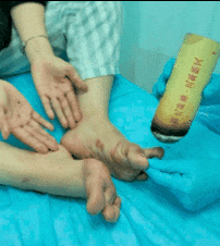 艾灸.gif