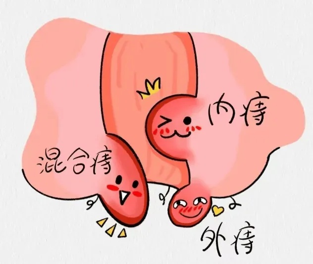内痔.jpg