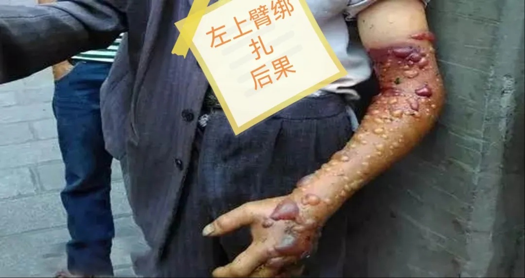 盲目捆扎肢体.jpg