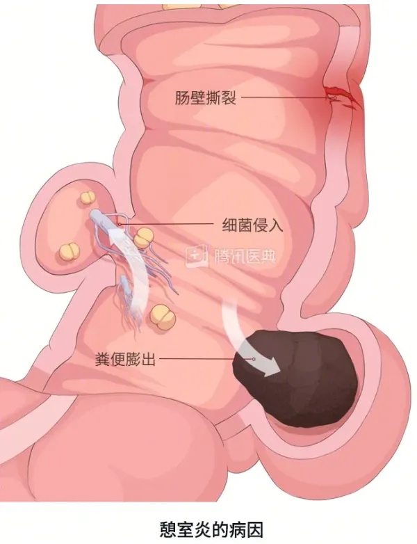 如果息肉是肠子里长出来的“凸起”.jpg
