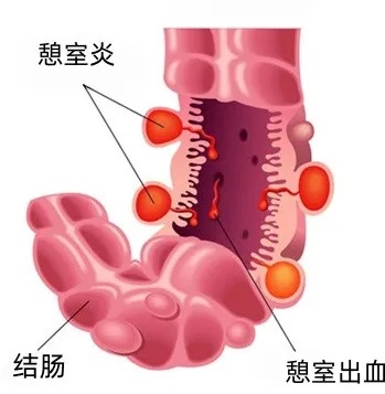 引发无痛性的大量便血.jpg