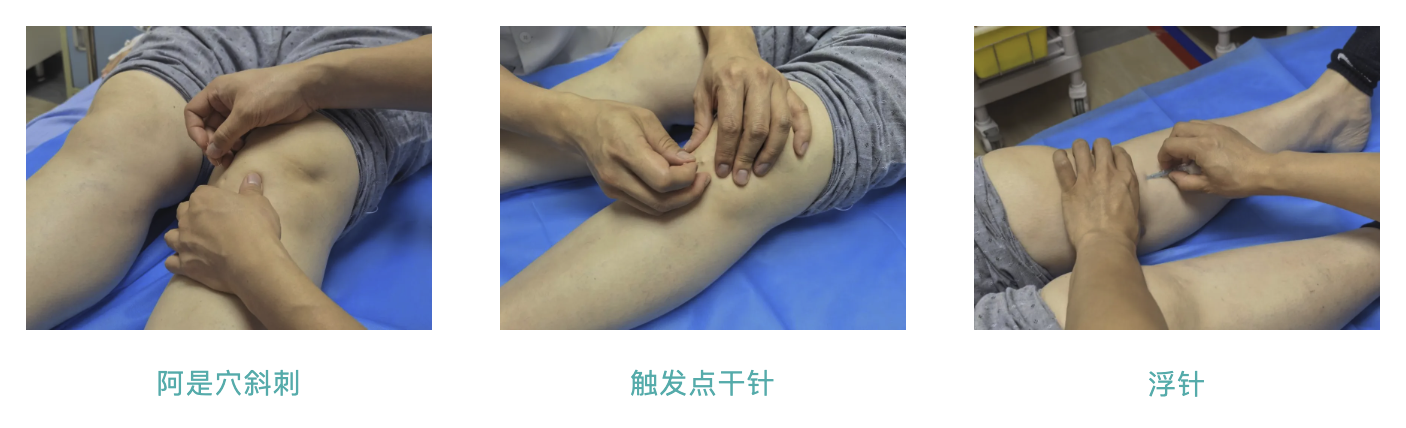 三个针法.png