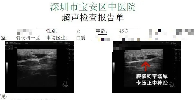 正中神经卡压.jpg