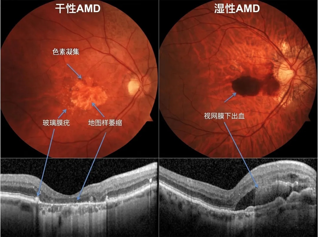 干性AMD和湿性AMD.jpg