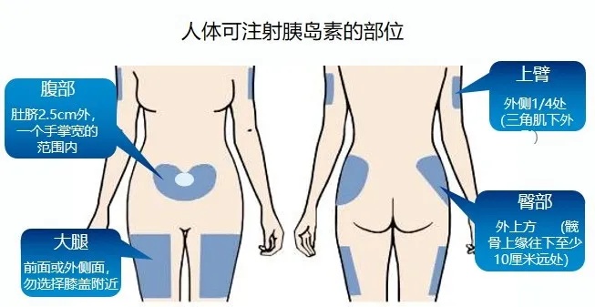人体可注射的部位.jpg